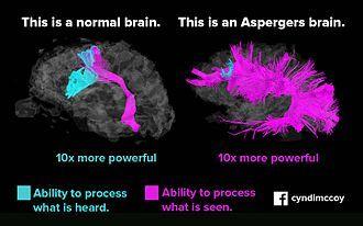 Image du cerveau Asperger