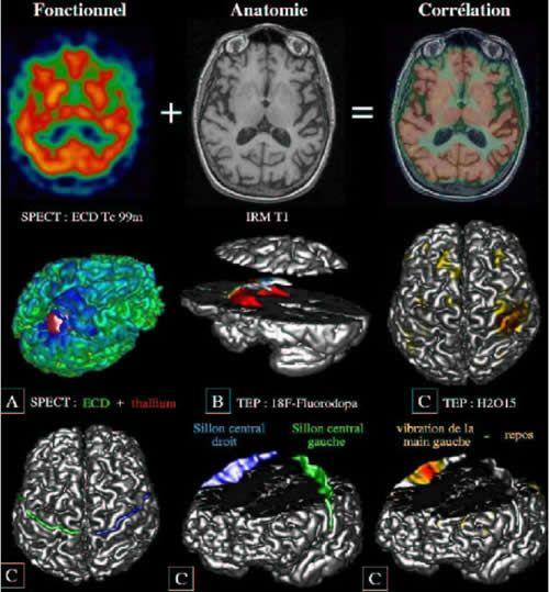 Anatomie du cerveau EEG et fonctionnelle