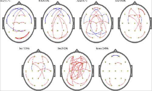 mapping brain et neurofeedback QEEG